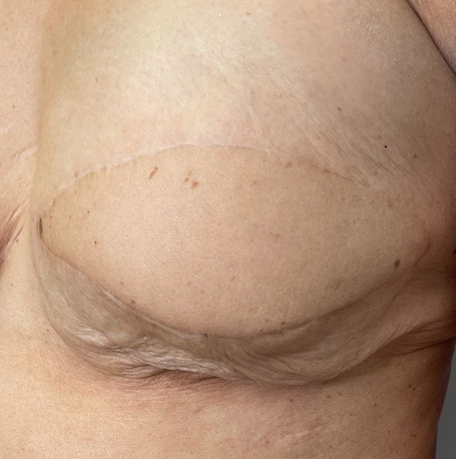 Before areola tattoo